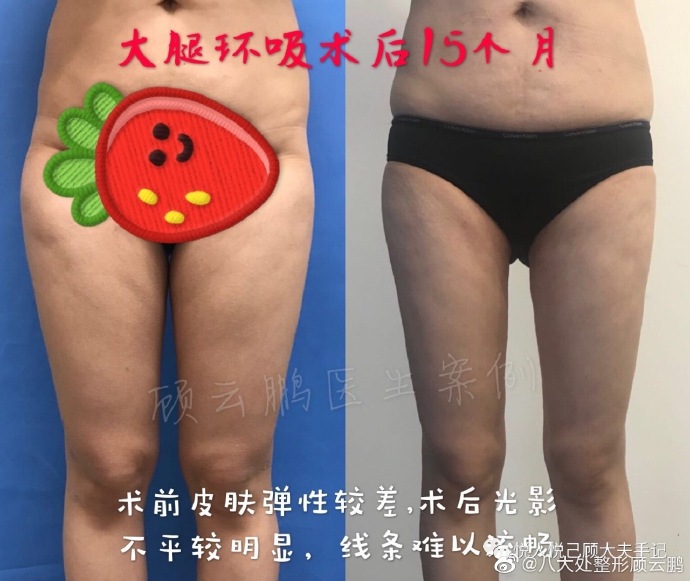 顾云鹏大腿吸脂案例