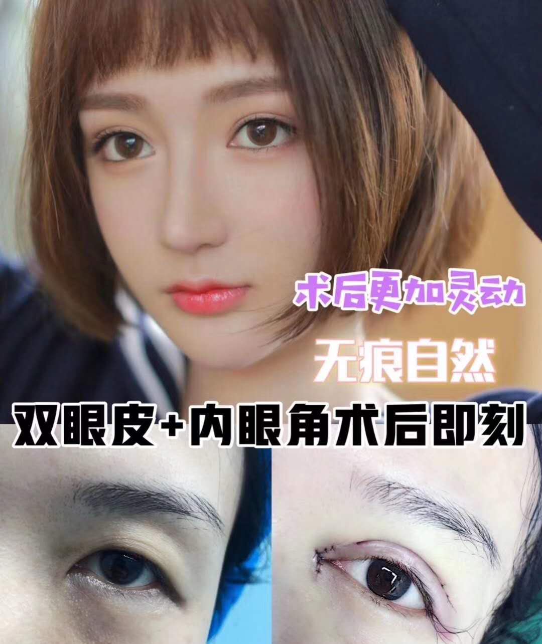 成都双眼皮手术哪家好？成都双眼皮医生排名