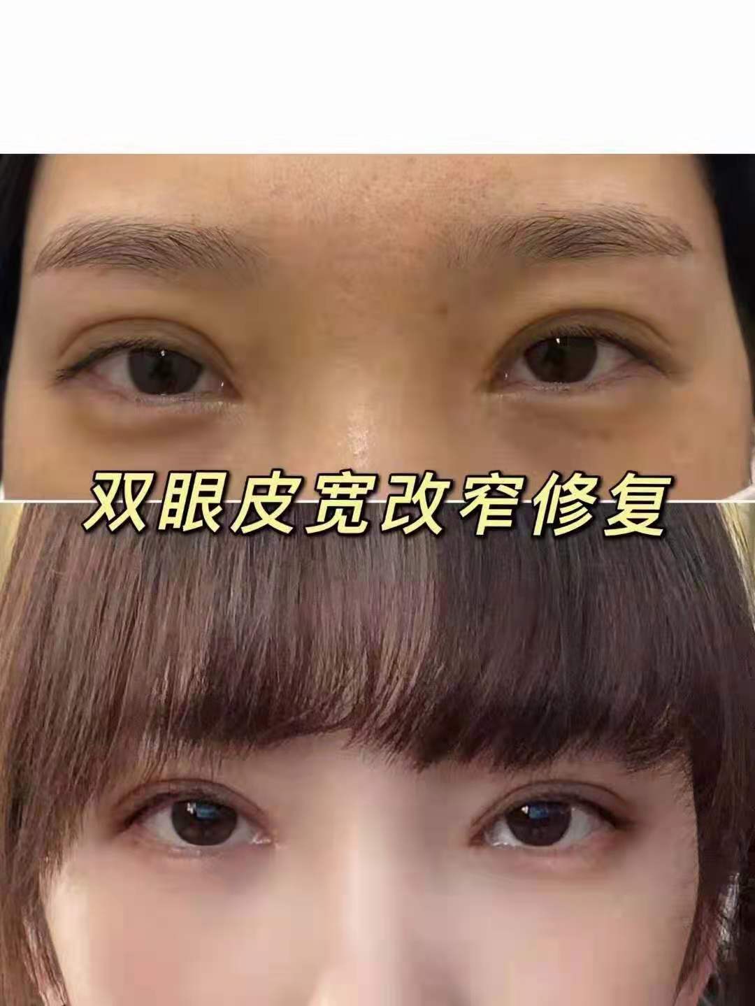 马晓飞修复双眼皮案例